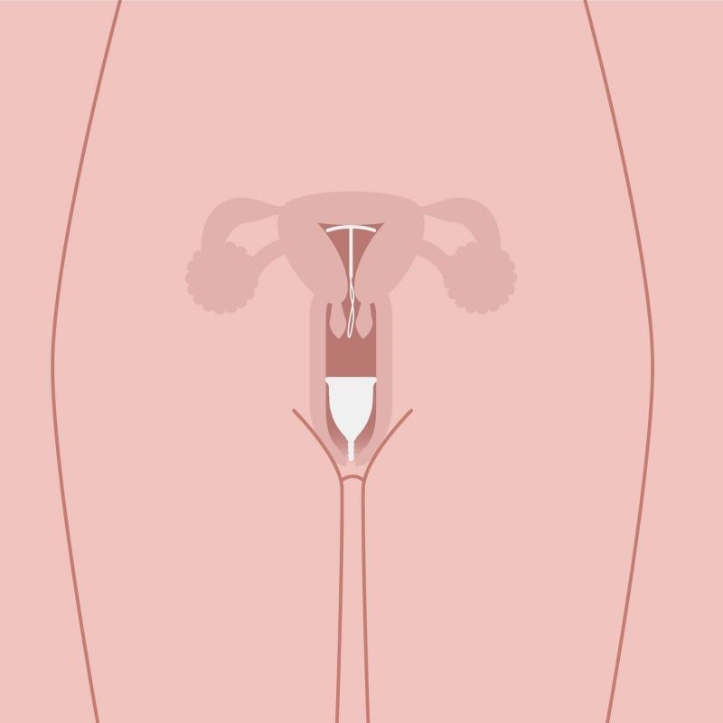 محل قرار گیری فنجان قاعدگی و آیودی در واژن